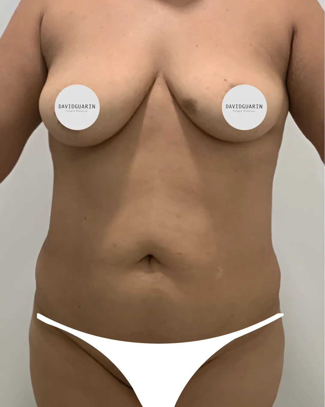 caso de abdominoplastia antes de cirugia 