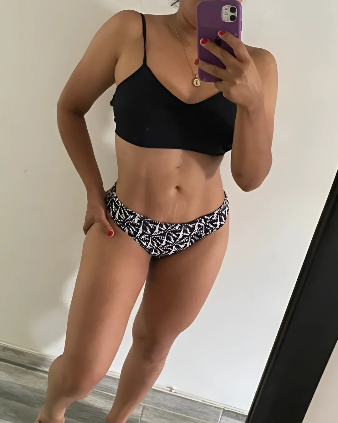 caso de abdominoplastia despues de cirugia