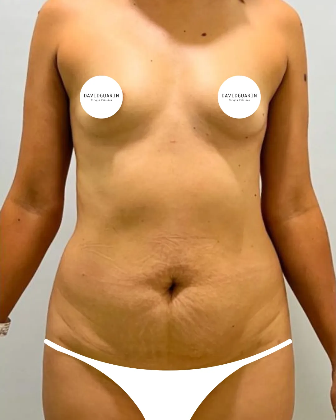 caso de abdominoplastia antes de cirugia