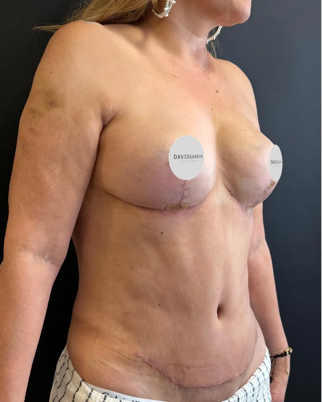 caso de abdominoplastia despues de cirugia