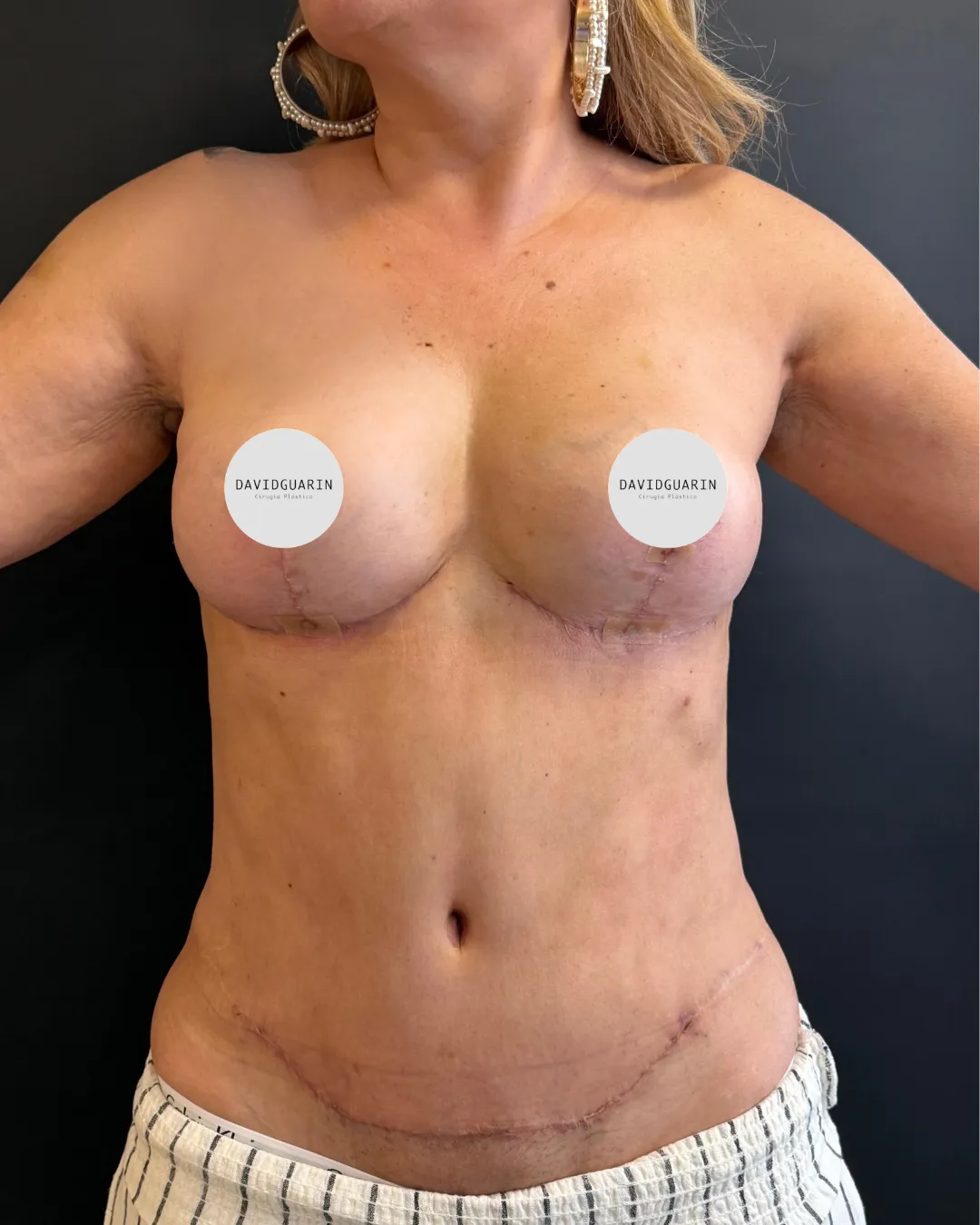 caso de abdominoplastia despues de cirugia