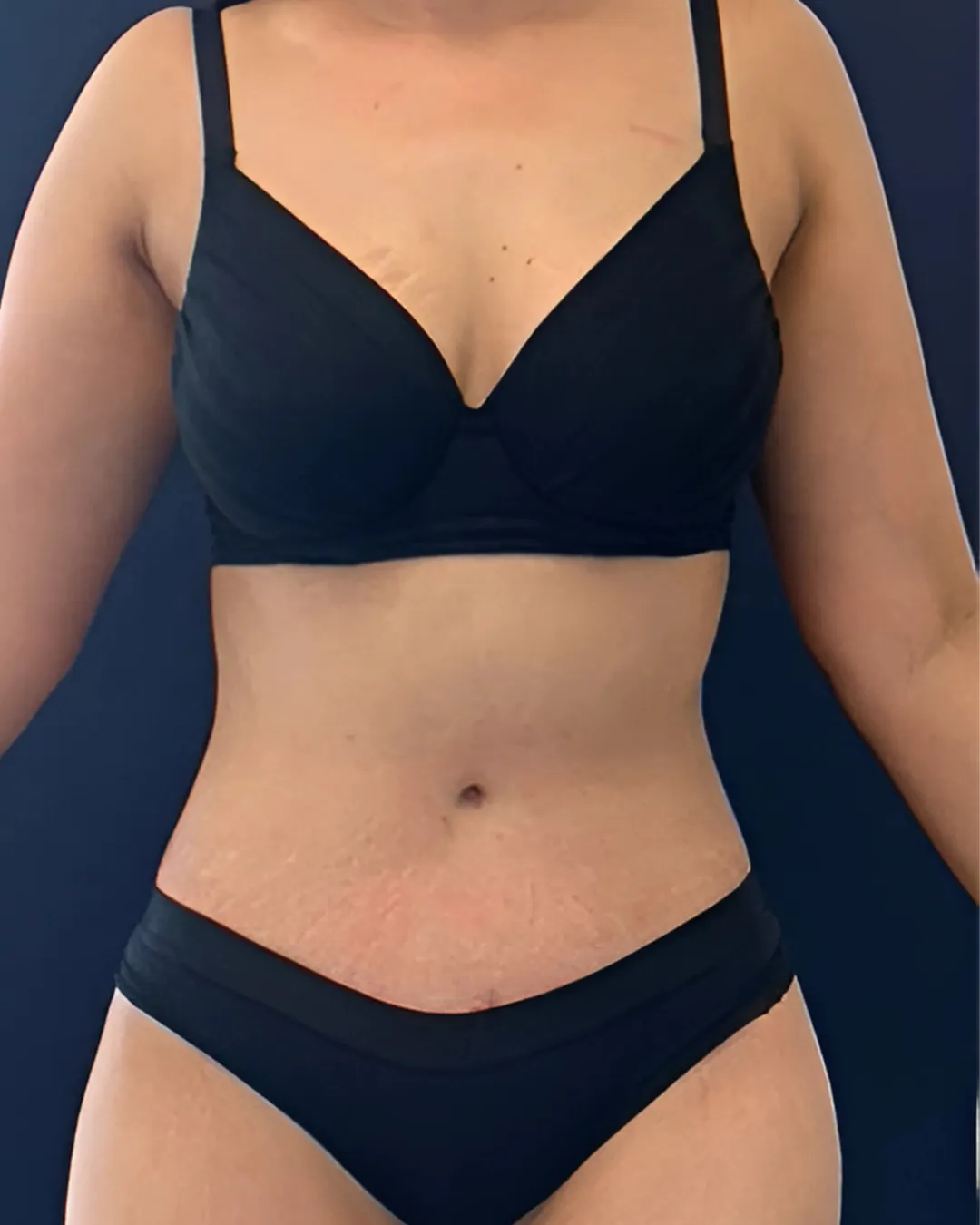 caso de abdominoplastia despues de cirugia