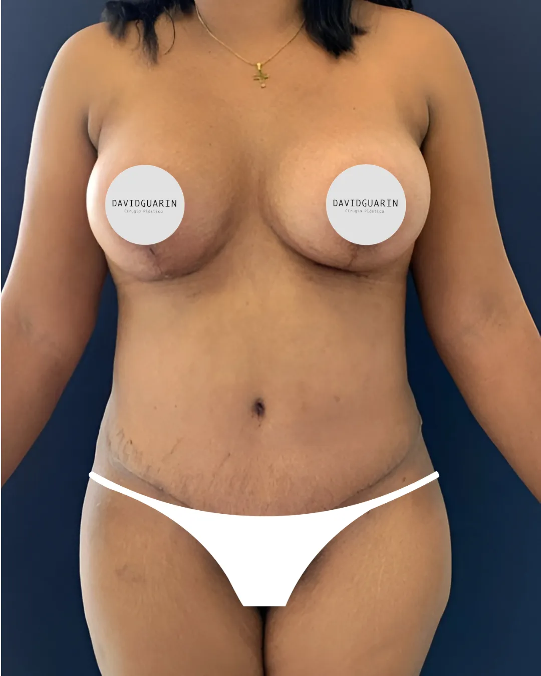 caso de abdominoplastia despues de cirugia