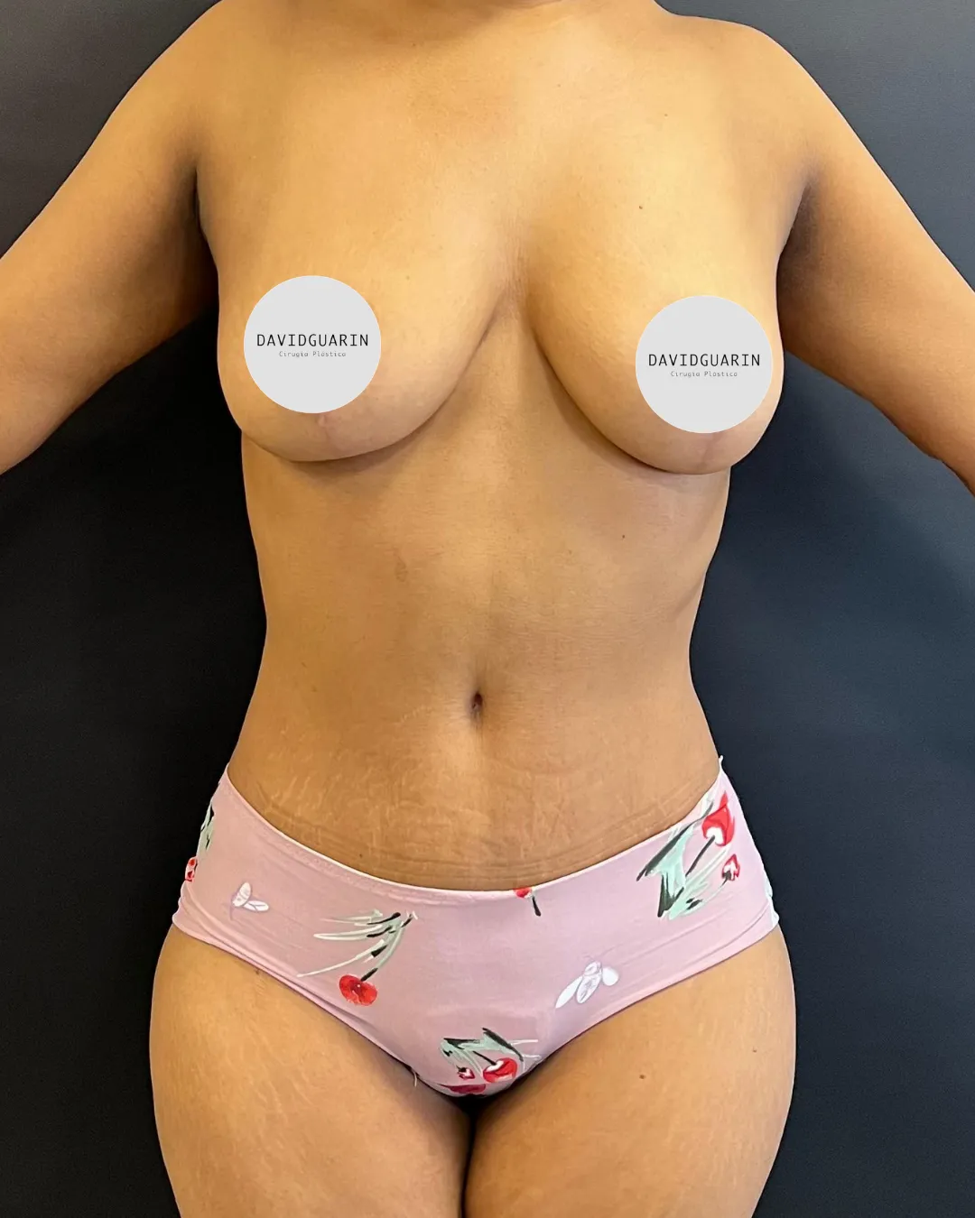 caso de abdominoplastia despues de cirugia