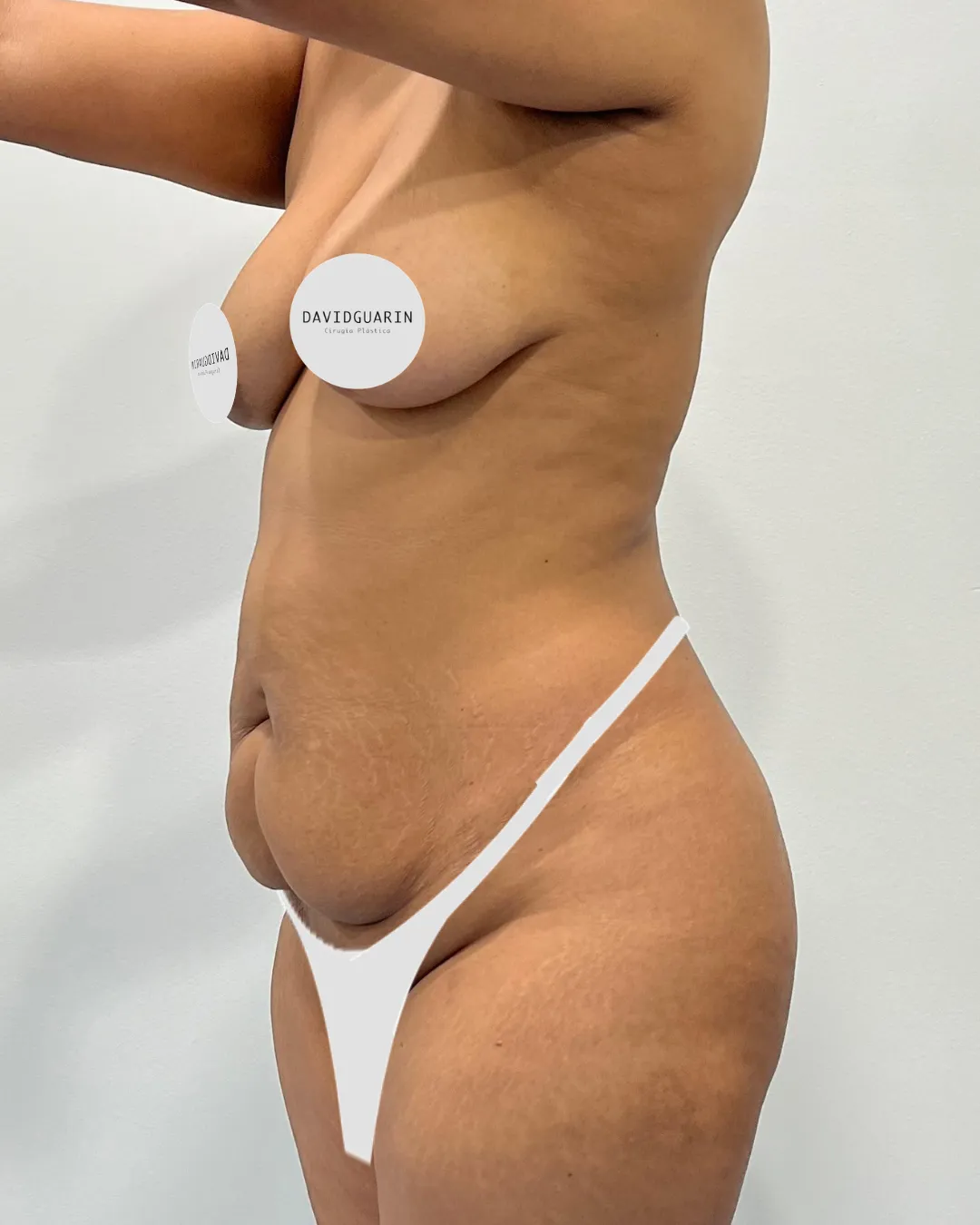 caso de abdominoplastia antes de cirugia 