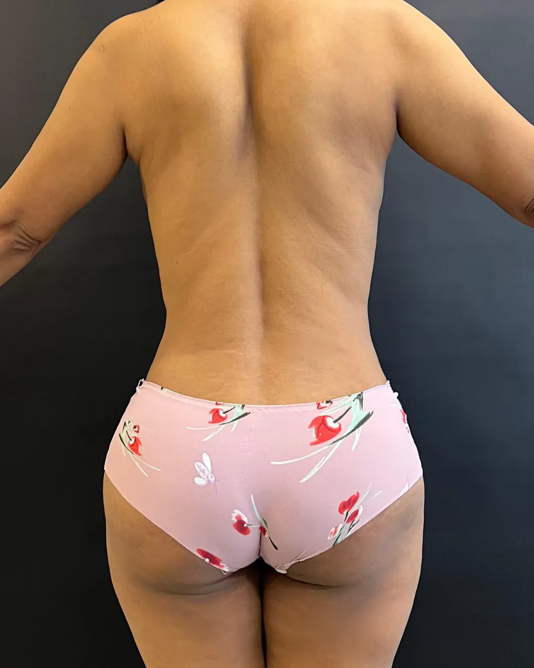 caso de abdominoplastia despues de cirugia