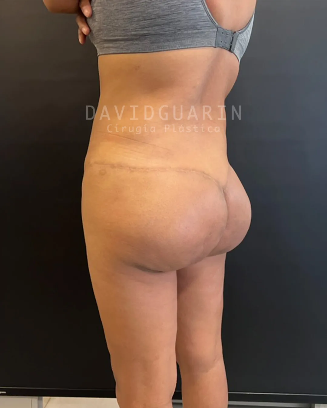 despues de cirugia de retiro de biopolimeros