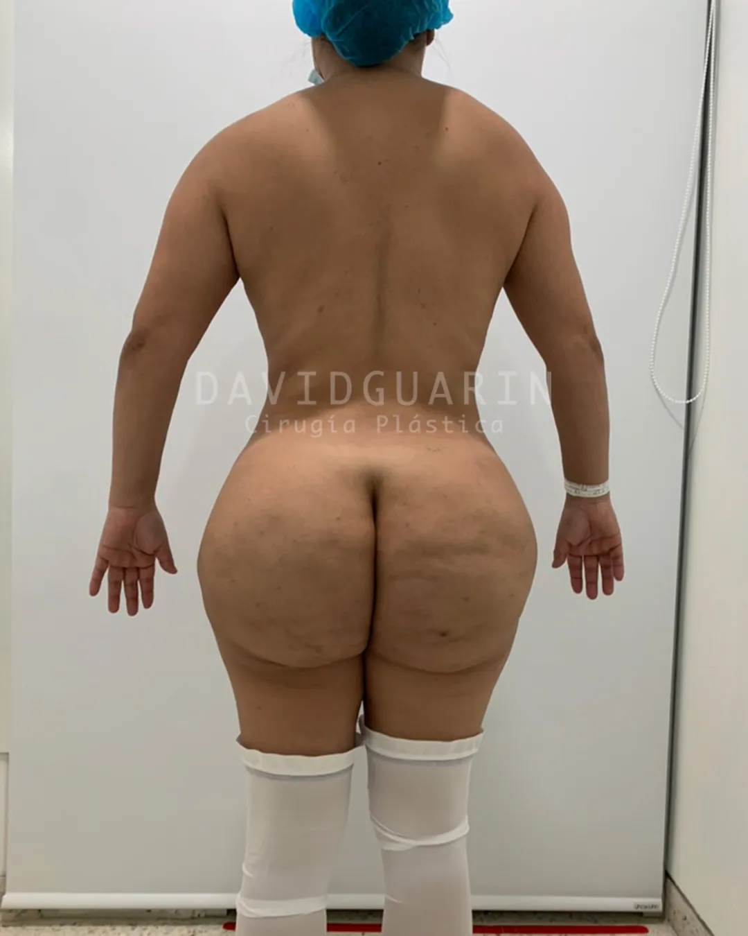 Antes de cirugia de retiro de biopolimeros