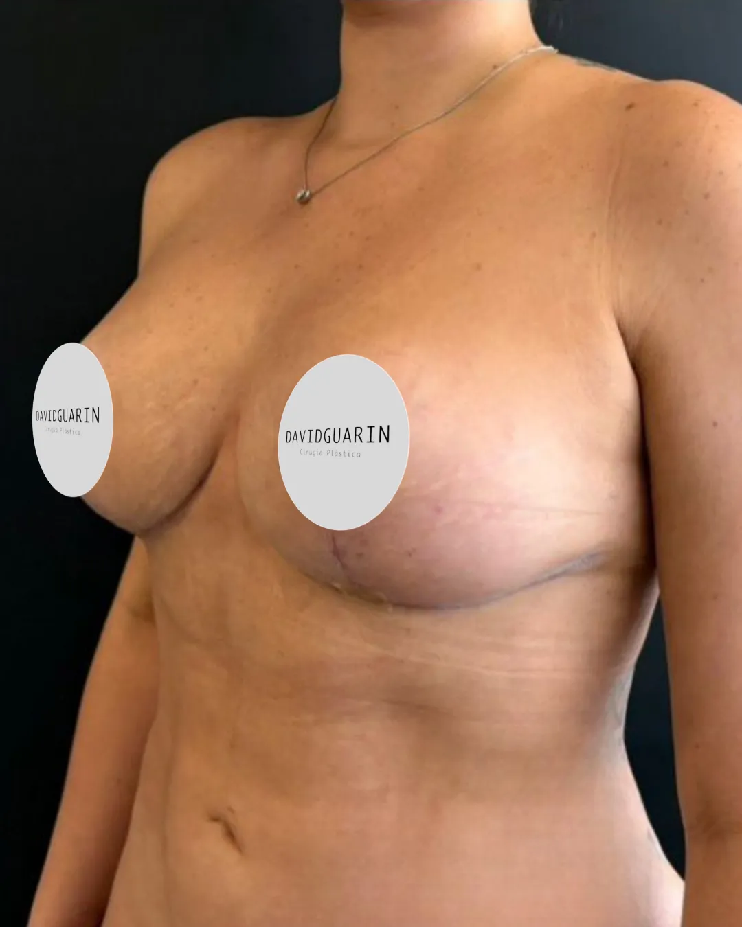 caso de explantacion mamaria despues de cirugia