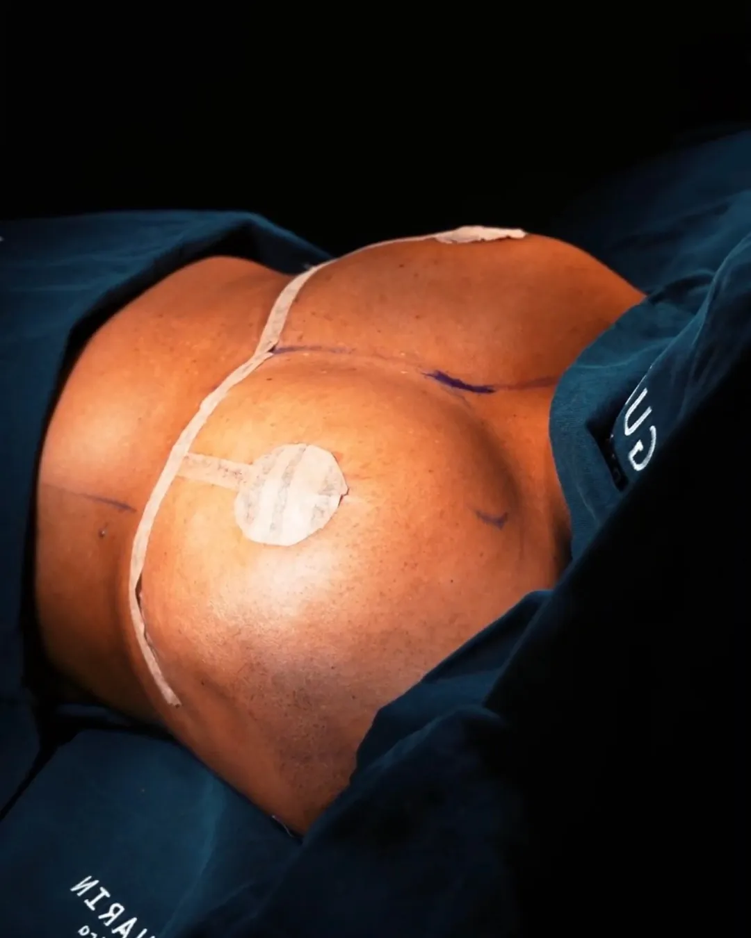 caso de explantacion mamaria despues de cirugia