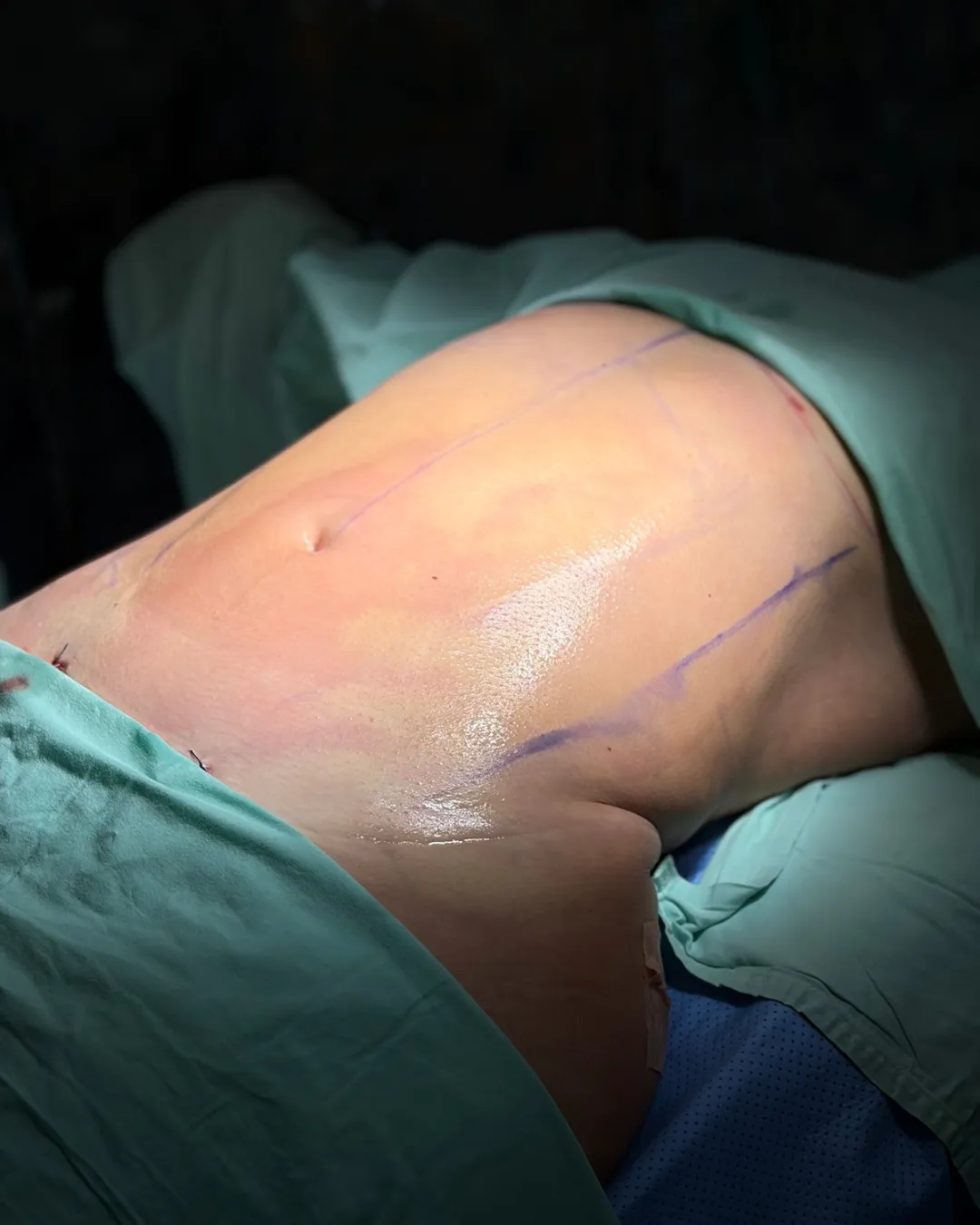caso de Lipoescultura despues de cirugia