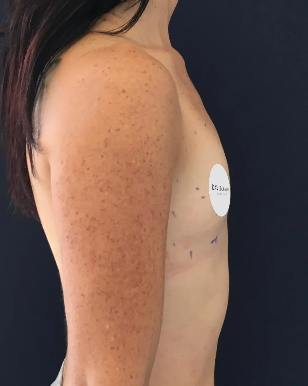 caso de Mamoplastia antes de cirugia 