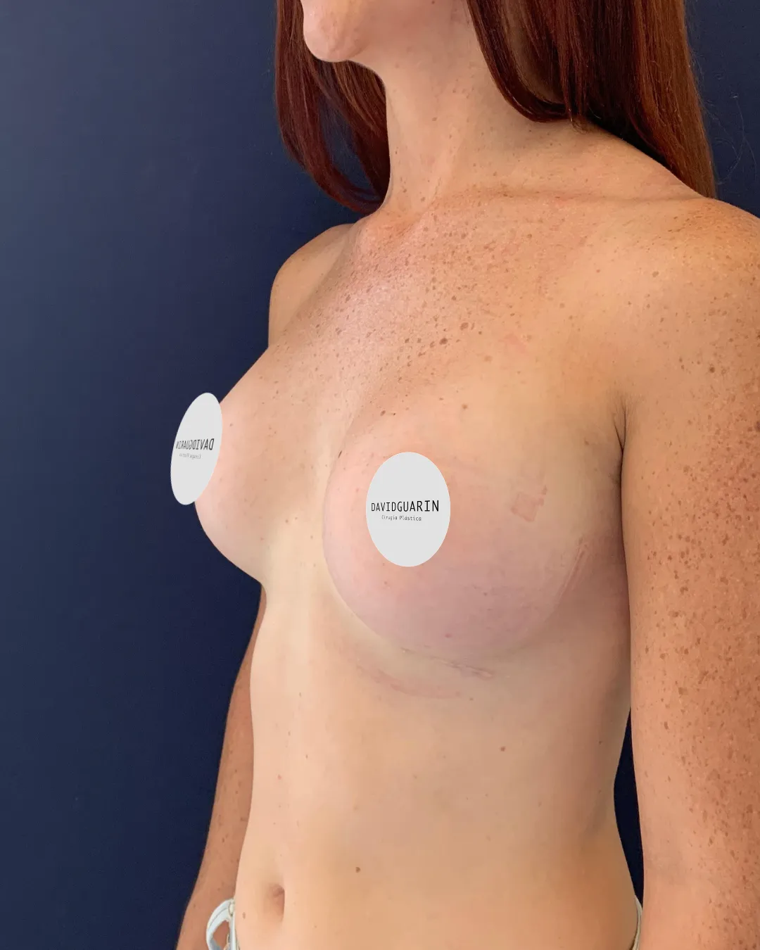 caso de Mamoplastia despues de cirugia