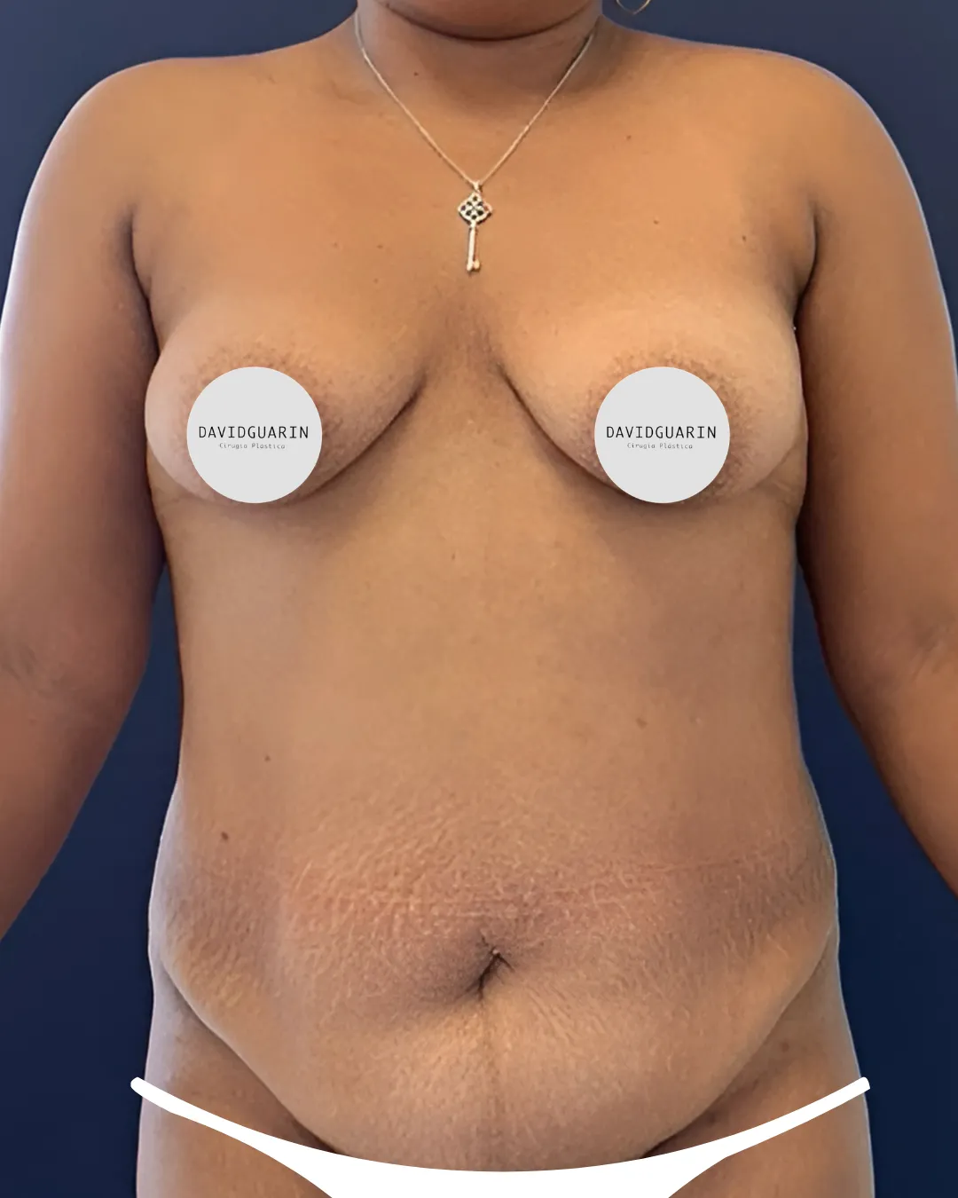 caso de Mamoplastia antes de cirugia