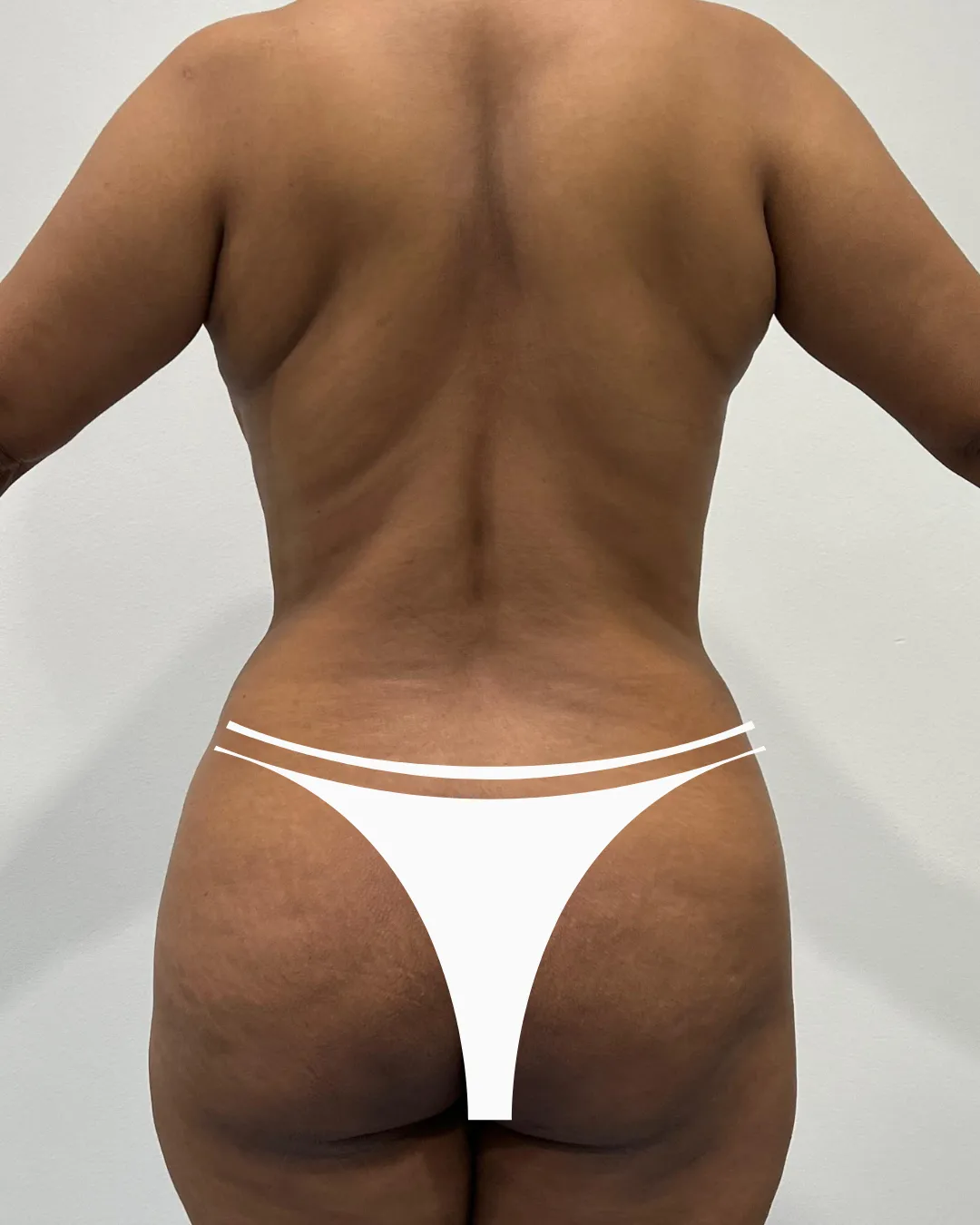 caso de Mommy makeover antes de cirugia  