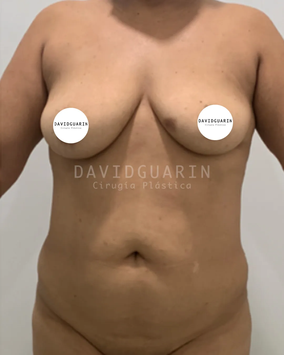 caso de Lipoescultura antes de cirugia
