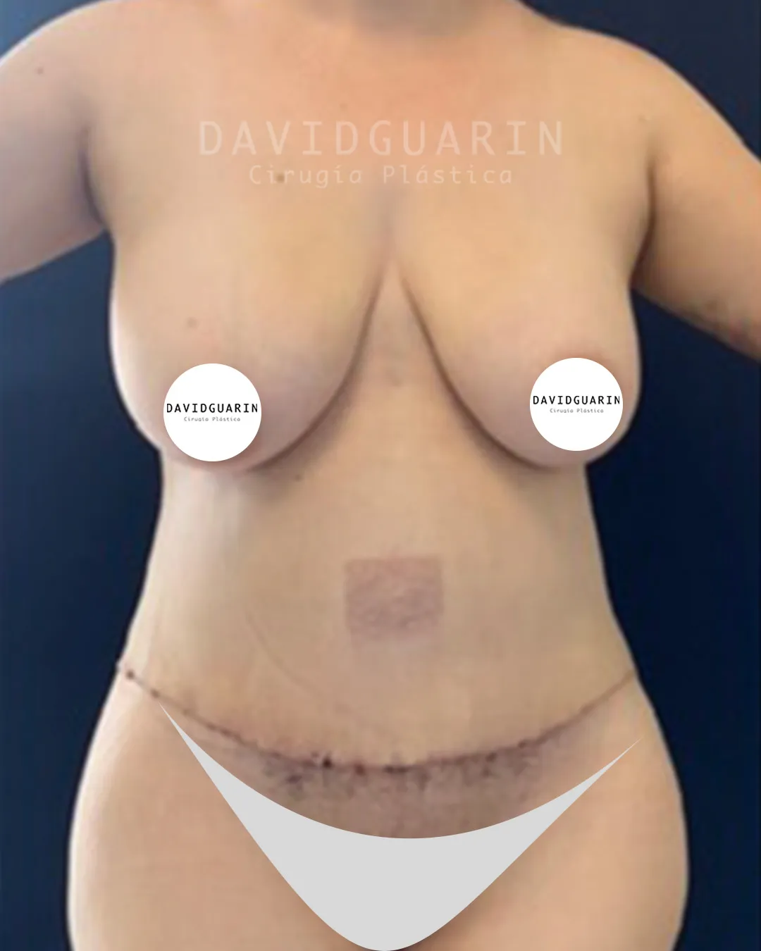 caso de Mommy makeover despues de cirugia