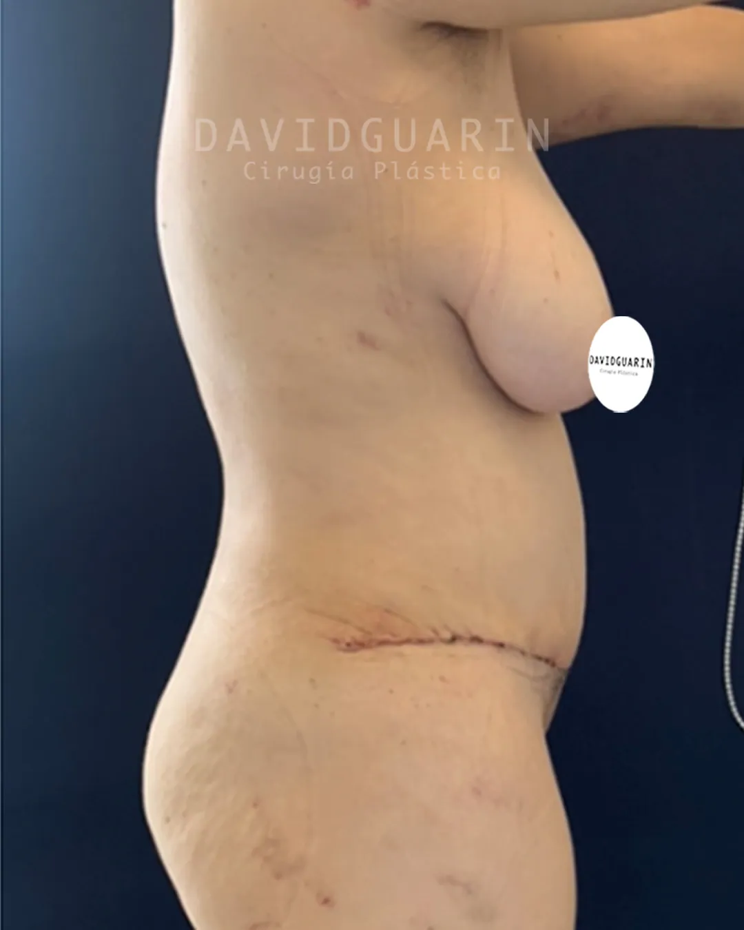 caso de Mommy makeover despues de cirugia
