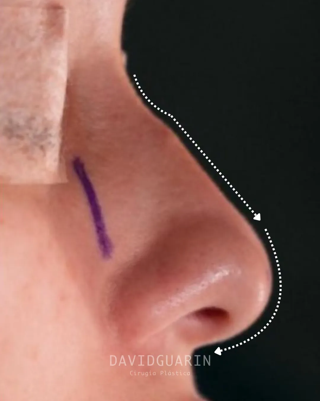 caso de Rinoplastia antes de cirugia 