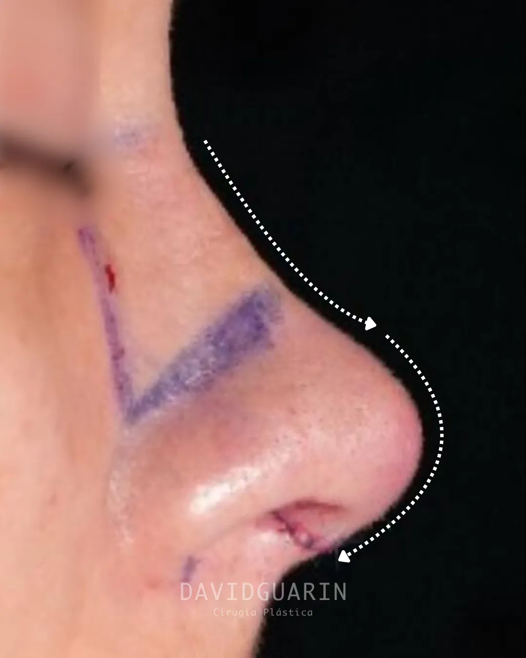 caso de Rinoplastia despues de cirugia