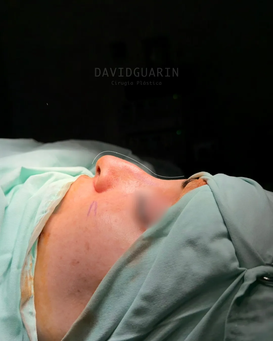 caso de Rinoplastia antes de cirugia