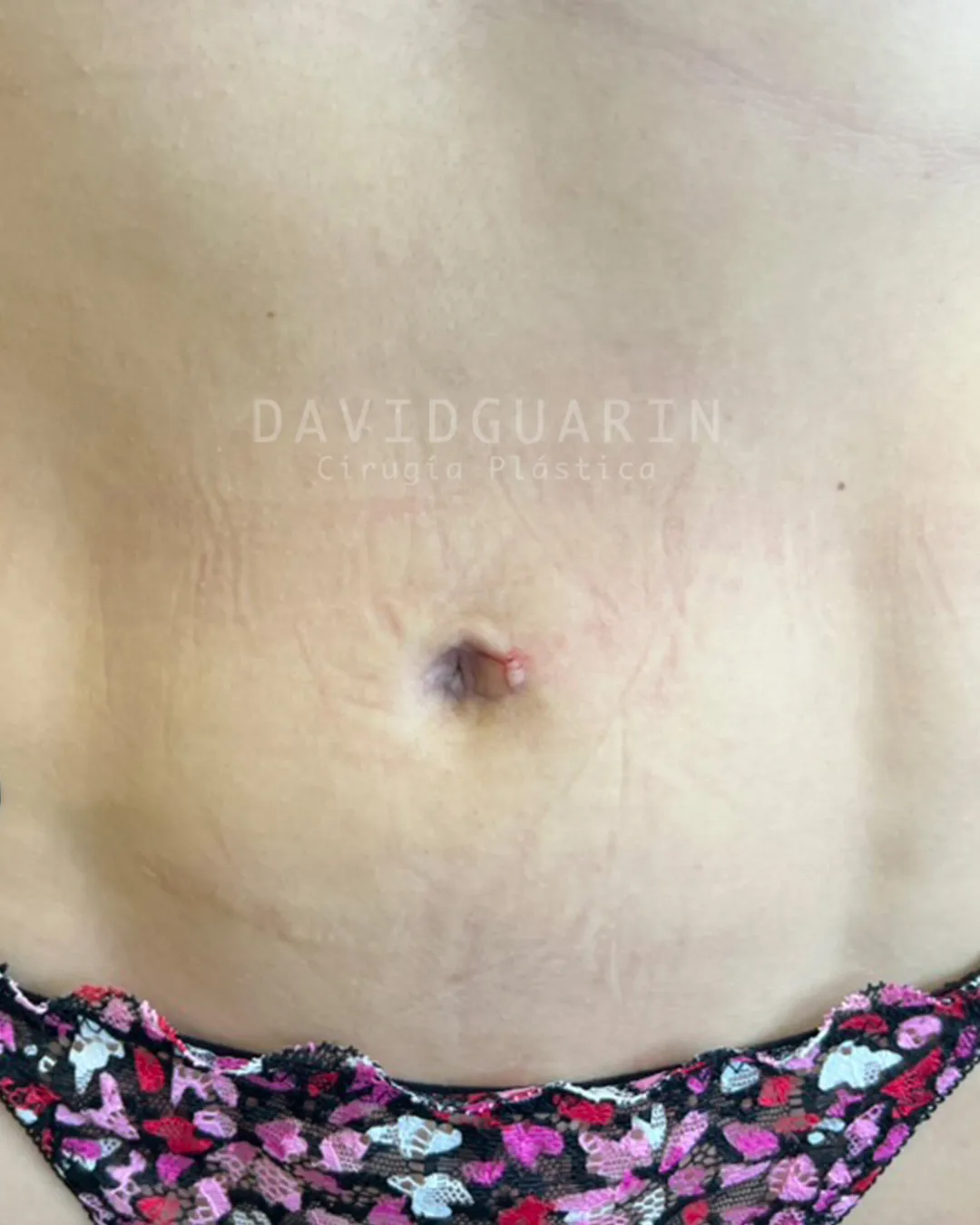 caso de Umbilicoplastia despues de cirugia